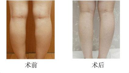 呼市腿部吸脂